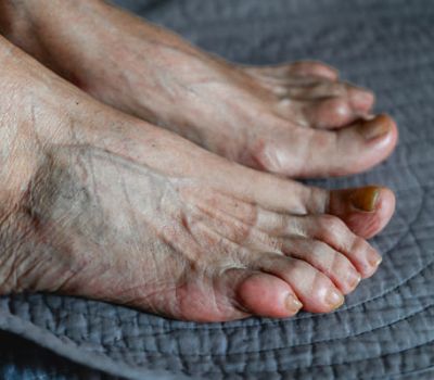 senior-woman-foot-with-medical-condition-arthriti-2025-02-18-19-59-59-utc (1) (1)